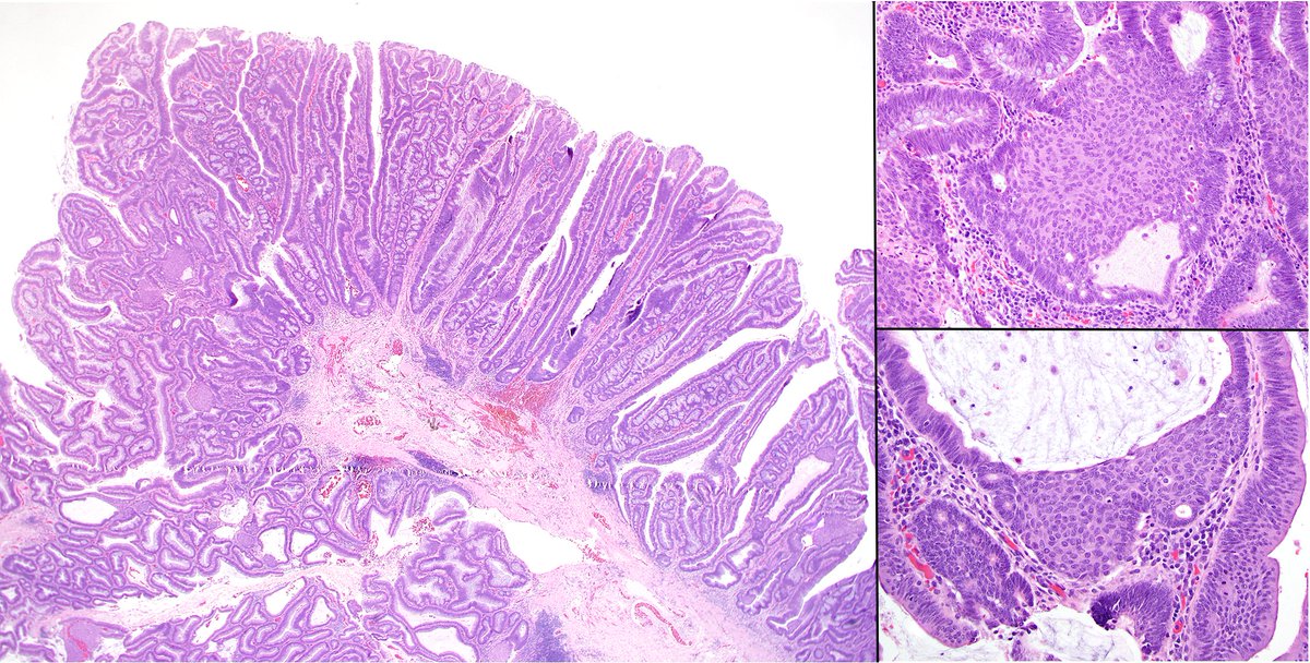 IAbukhiran's tweet photo. Occasionally, morular metaplasia in an ordinary colon adenoma can be mistaken for foci of high-grade dysplasia due to its “pseudo loss of polarity” appearance. 
#GI_Path https://t.co/3k823kYYUP