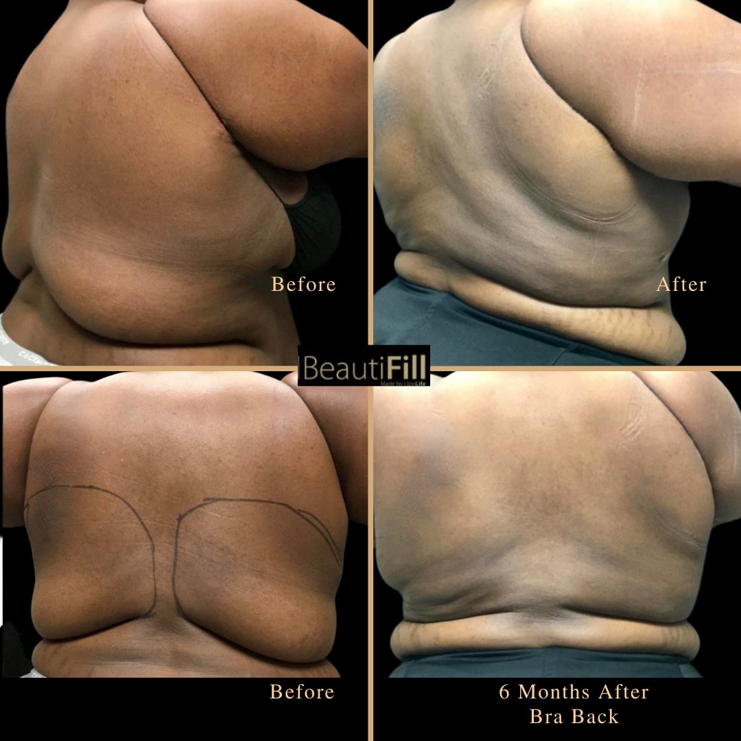 Allure Wellness Center on X: Bra fat (or the bulge) is only one of the  areas that a BeautiFill #laserliposuction can treat. Check out our Gallery  that shows some magnificent before and
