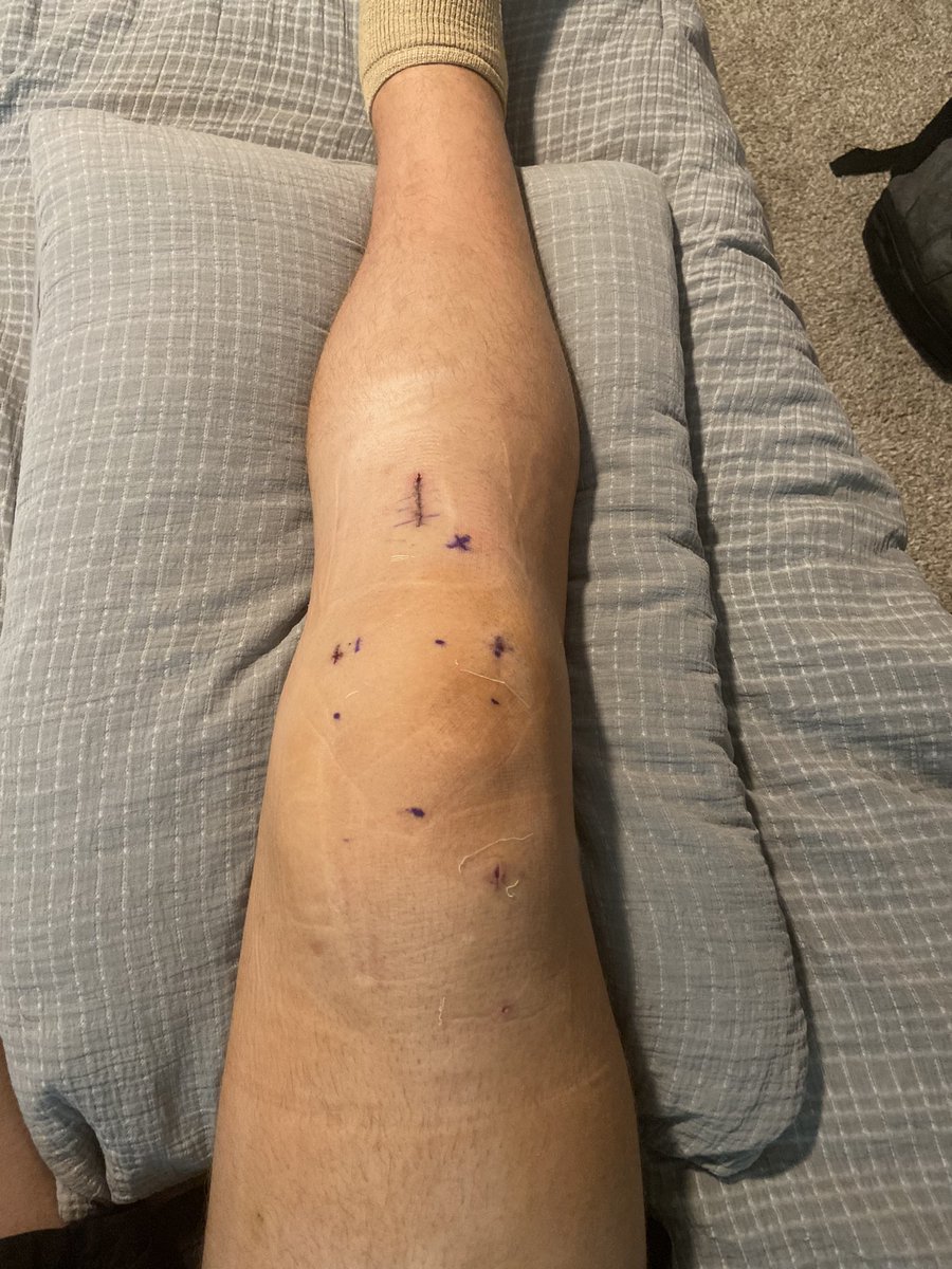 Eli_finley1's tweet photo. 7 months ago 1 month before my junior season I tore my acl…Glory to god surgery went well and I am 100% cleared.Wouldn’t be where I am today with out my family and coaches pushing me.Can’t wait to get back out there with my boys.@HeathSportsMed @JohnHarrell_BNC @ORUMSoccer https://t.co/ifkppShqE1