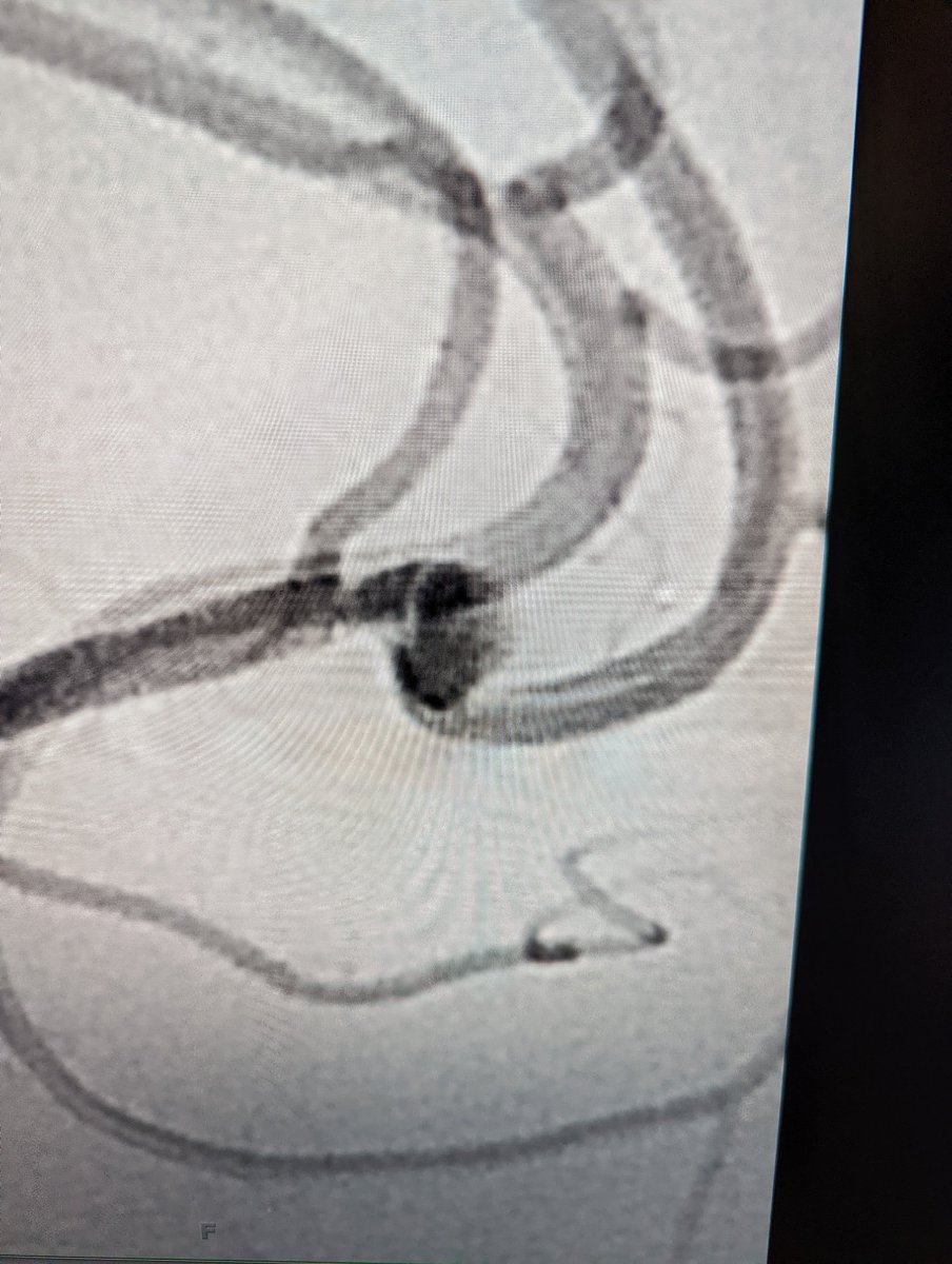 NIRAbbott's tweet photo. Post detachment angiogram showed complete aneurysm occlusion w patency of the callosomarginal artery
#JustWEBit #WEB17 @MV_Terumo https://t.co/QZVyn8gxfp