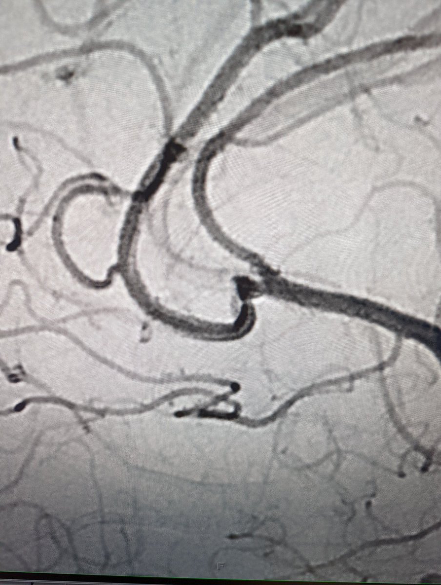 NIRAbbott's tweet photo. Follow-up up angiogram 6 months after treatment
#JustWEBit #WEB17 @MV_Terumo https://t.co/MOfrRKYkio