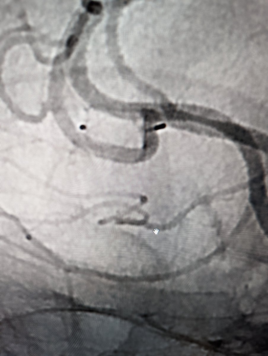 NIRAbbott's tweet photo. Follow-up up angiogram 6 months after treatment
#JustWEBit #WEB17 @MV_Terumo https://t.co/MOfrRKYkio