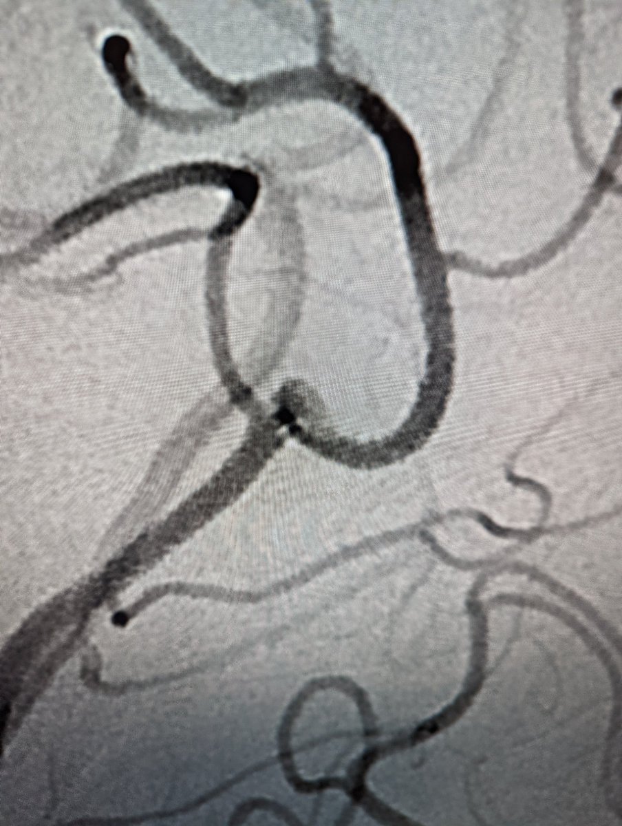 NIRAbbott's tweet photo. Follow-up up angiogram 6 months after treatment
#JustWEBit #WEB17 @MV_Terumo https://t.co/MOfrRKYkio