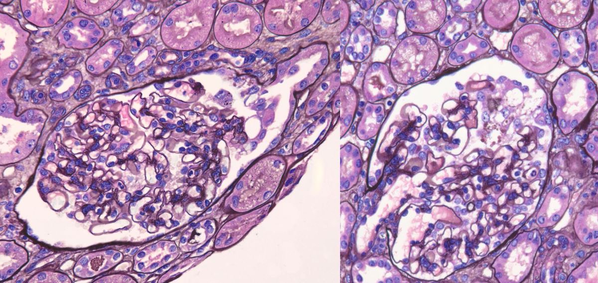 Timid Tip Lesion FSGS: 25 yo M with sudden onset nephrotic syndrome.  The biopsy revealed very delicate and bashful tip lesions gently 'kissing' the tubular pole, and other glomeruli that are still in stages of contemplation...