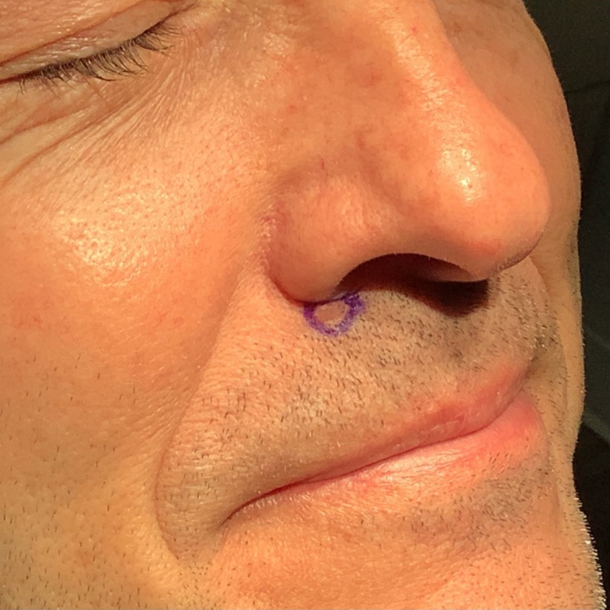 MohsCollege's tweet photo. #FlapFriday- Mohs cases on the lip-even the cutaneous lip-require consideration of limited tissue to recruit and respect of the free margin. A modified O-to-T (or perialar cresentic advancement) was chosen to close the defect without distortion of the vermillion border. https://t.co/oRPp4I2keb