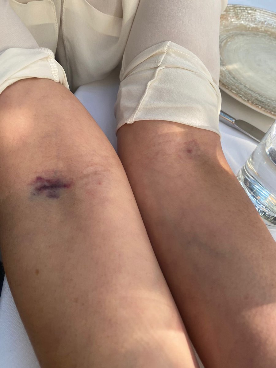 carolina_rocha_'s tweet photo. Esta tarde mi hermana pagó por una prueba de sangre en la que la trataron peor que en carnicería. Una toma de sangre y tres personas porque las dos primeras eran inexpertas. Horror y se cobra. Esto hizo @QuestDX en sus brazos. Cuidado con lugares improvisados que dicen saber. https://t.co/rOHwFuiQTO