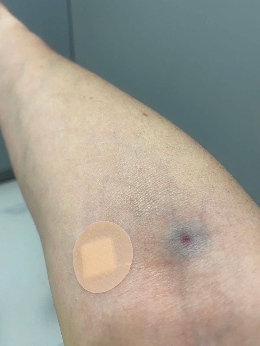carolina_rocha_'s tweet photo. Esta tarde mi hermana pagó por una prueba de sangre en la que la trataron peor que en carnicería. Una toma de sangre y tres personas porque las dos primeras eran inexpertas. Horror y se cobra. Esto hizo @QuestDX en sus brazos. Cuidado con lugares improvisados que dicen saber. https://t.co/rOHwFuiQTO