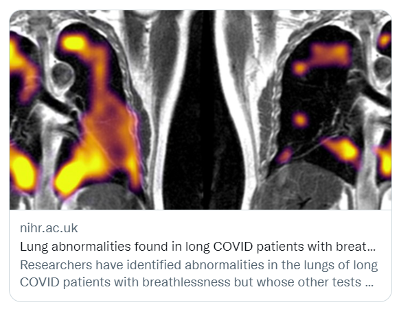 🆕Des chercheurs ont identifié des anomalies dans les poumons de patients #CovidLong souffrant d'essoufflement mais dont les autres examens sont normaux!

L'étude EXPLAIN utilise des scanners IRM au xénon hyperpolarisé (suite ⬇️)
#ApresJ20