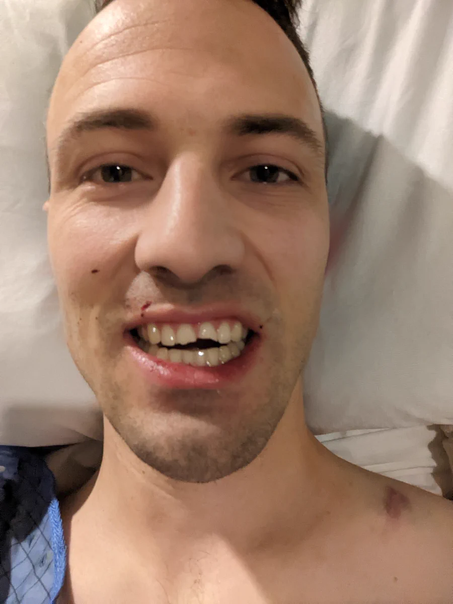 Kent in a hospital bed with broken teeth and a broken collarbone that appears bruised.