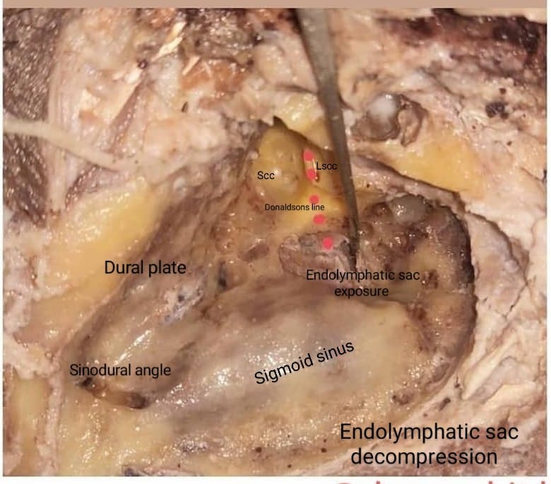 entkmcmlr's tweet photo. Temporal bone dissection by our postgraduates https://t.co/AqoPHHEgnF