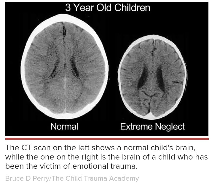Hindari memukul dan berkata kasar pada anak/murid. Kenapa? Perbandingan hasil CT scan pada dua anak usia 3 tahun ini menunjukkan ukuran otak mengecil pada anak yg trauma akibat kekerasan fisik & verbal. Ini menurunkan kemampuan memori, motorik, sosialisasi, memecahkan masalah.