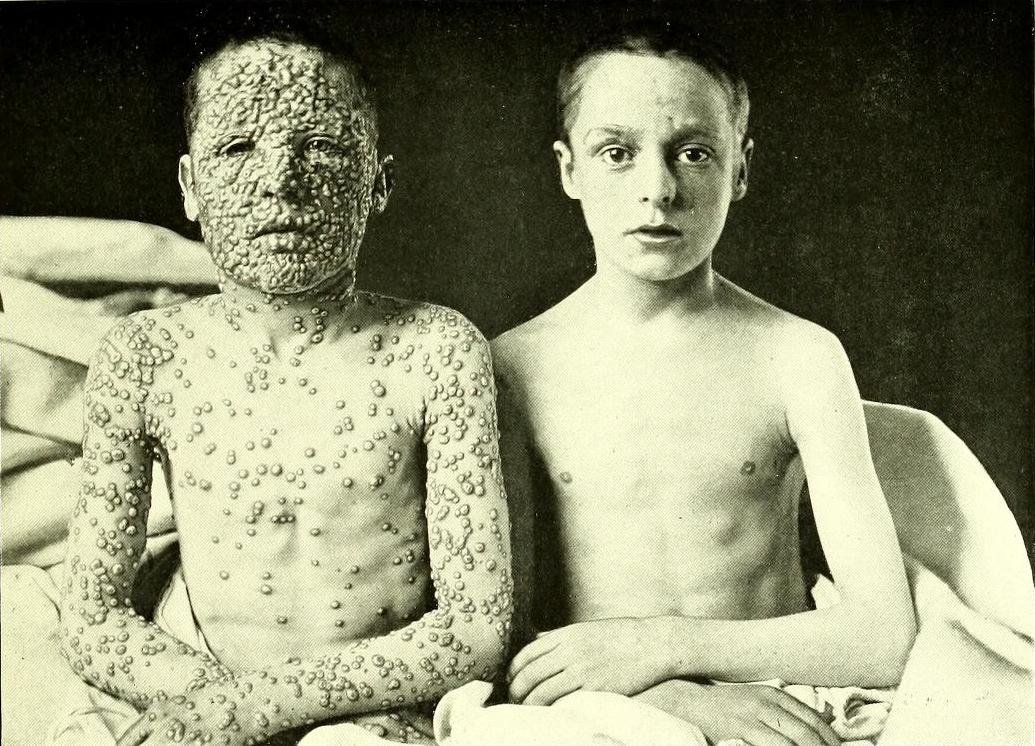 Allan Warner (1901). Hospital de Leicester. Niño no vacunado contra la viruela.