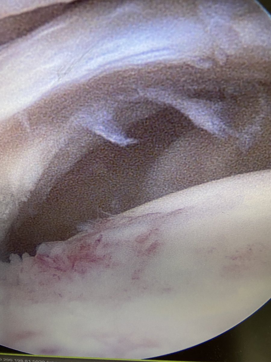 DrBrettSanders's tweet image. Transosseous cuff repair=value based medicine