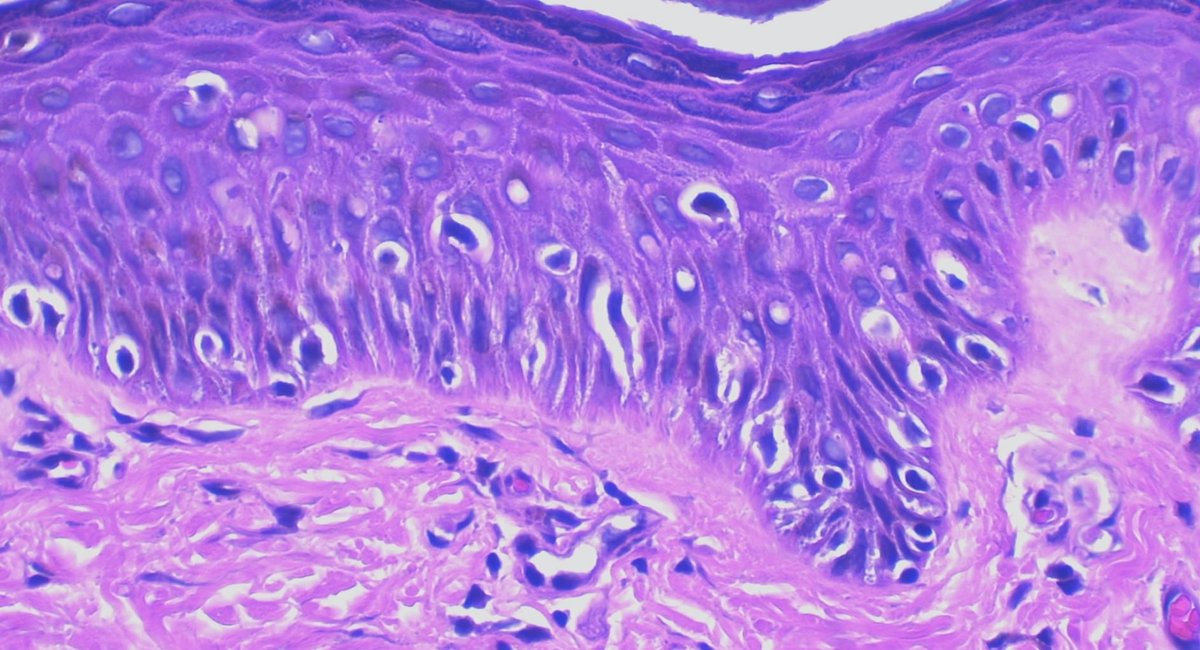 JCandidoXavier's tweet photo. M elanocytic
A cral
N evus with
I ntraepidermal
A scent of
C ells
It is usually a small lesion in youngsters showing suprabasal scatter of melanocytes.
It is not #melanoma 😉
#melanoma #Pediatrics #path #dermopath #dermatopathology #dermatology #surgpath #patología https://t.co/2d4v8gogDZ