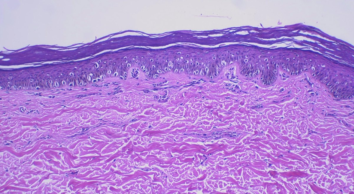JCandidoXavier's tweet photo. M elanocytic
A cral
N evus with
I ntraepidermal
A scent of
C ells
It is usually a small lesion in youngsters showing suprabasal scatter of melanocytes.
It is not #melanoma 😉
#melanoma #Pediatrics #path #dermopath #dermatopathology #dermatology #surgpath #patología https://t.co/2d4v8gogDZ