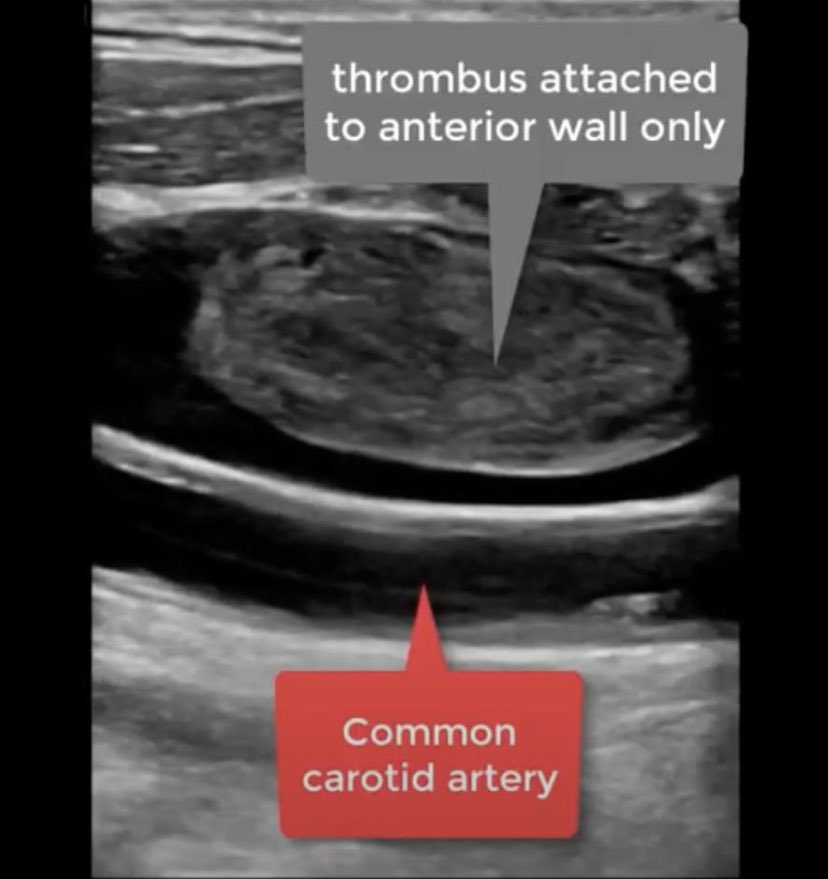 ABCvascular's tweet photo. While scanning the carotid arteries is always good to keep an eye on the veins #ultrasound #dvt #clot #radiology #medicine #learning https://t.co/DY8D2FUjUo