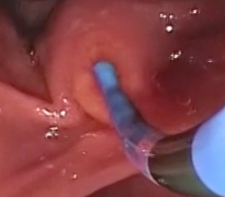 tberzin's tweet photo. Today I learned from the great Marty Freeman (@UMN_GI) that he uses tapered tip catheter for epi injection during ERCP for post-sphincterotomy bleeding: 
1) Easier to get over elevator vs needle
2) Less likely to cause mucosal tear/scrape
3) Allows for effective SM injection https://t.co/DLtWiDMQ2i