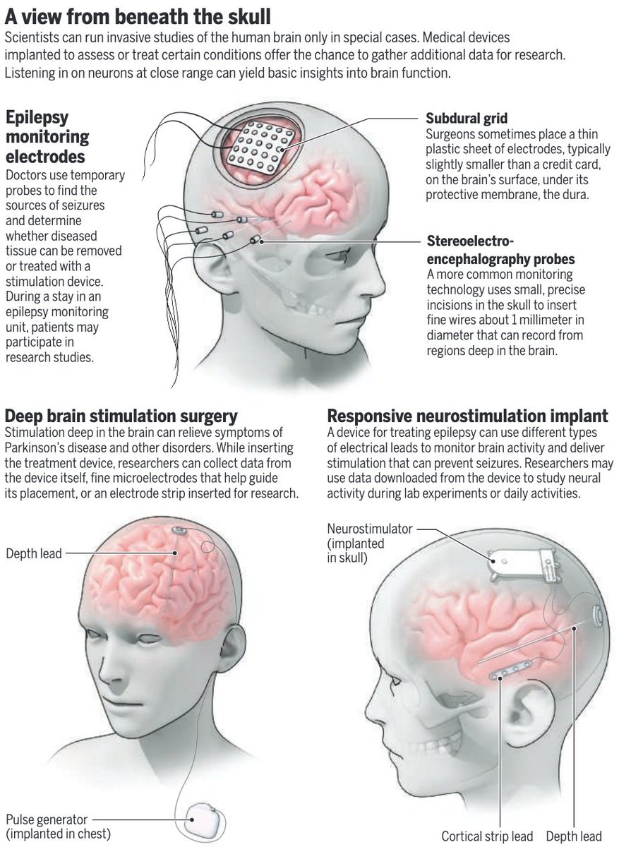 Science Magazine (@sciencemagazine) on Twitter photo Surgeries are increasingly opening patients’ brains to research. But the opportunities that come with this intimate access also raise complex ethical issues. Learn more: fcld.ly/w8dsaz7 <a href="/ScienceVisuals/">Science Visuals</a> Surgeries are increasingly opening patients’ brains to research. But the opportunities that come with this intimate access also raise complex ethical issues. Learn more: fcld.ly/w8dsaz7 <a href="/ScienceVisuals/">Science Visuals</a>
