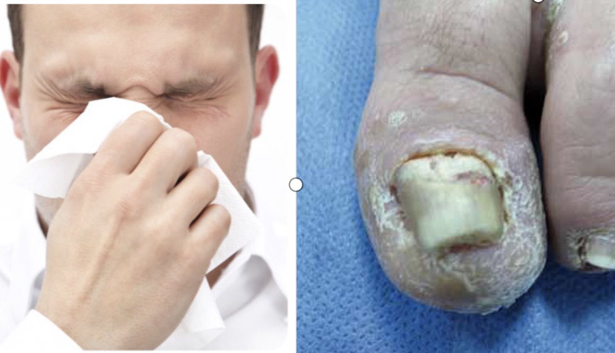 corresponsalcln's tweet photo. - La OMICRONMICOSIS no existe 
- La omicronmicosis …

#medicina #COVID19 #Pandemie 
Si usted no es médico, no opine 🤚🏻 https://t.co/SHd5bCmTzH