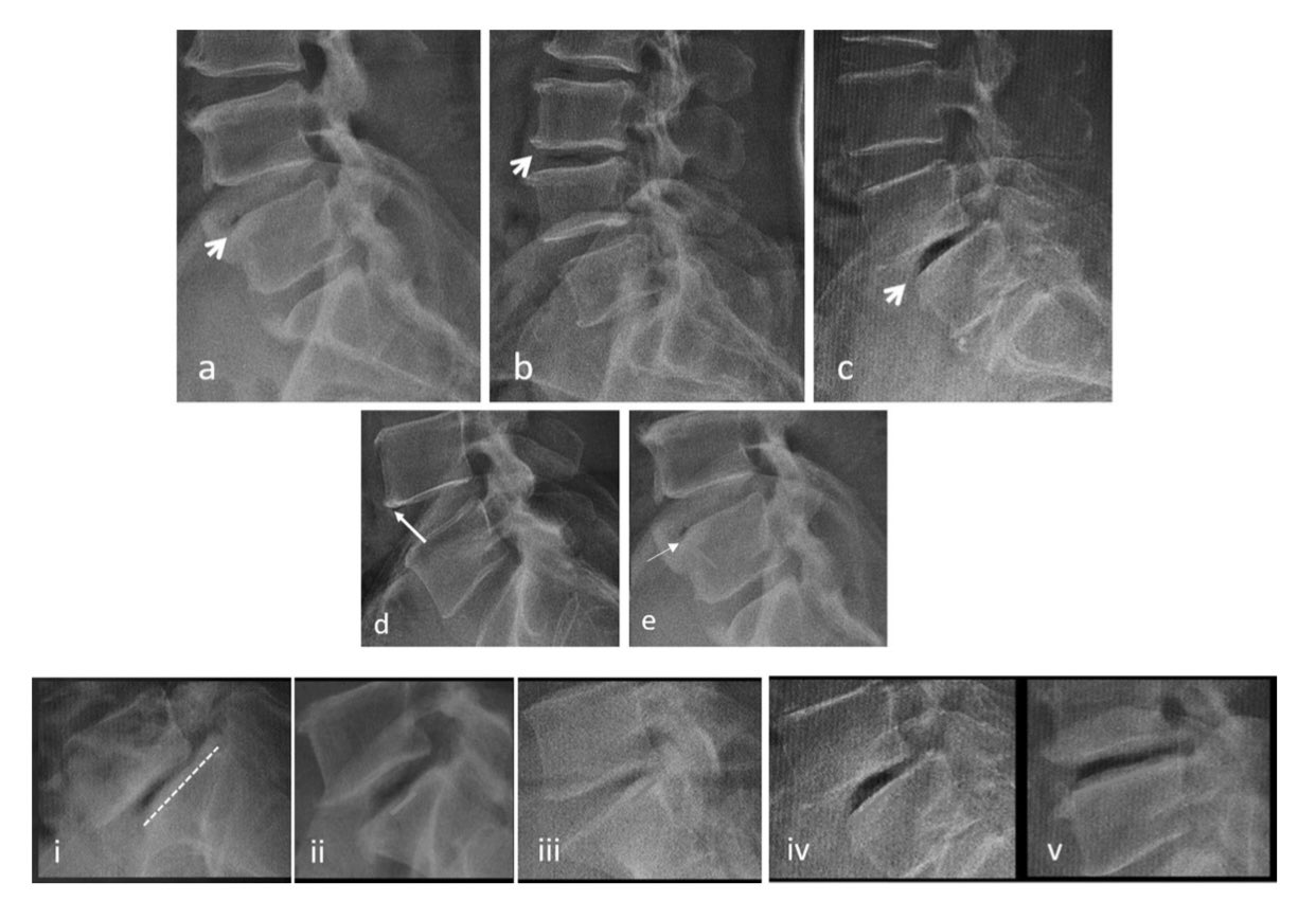 European Spine J on Twitter "Advanced disc degeneration, biplanar