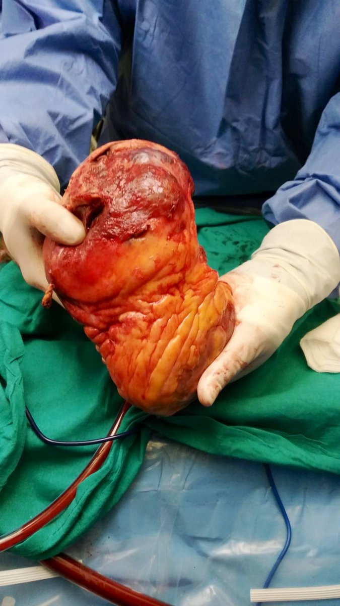 Giant unresectable benign cardiac tumor (lymphangioma). Atypical indication for heart transplantation ...