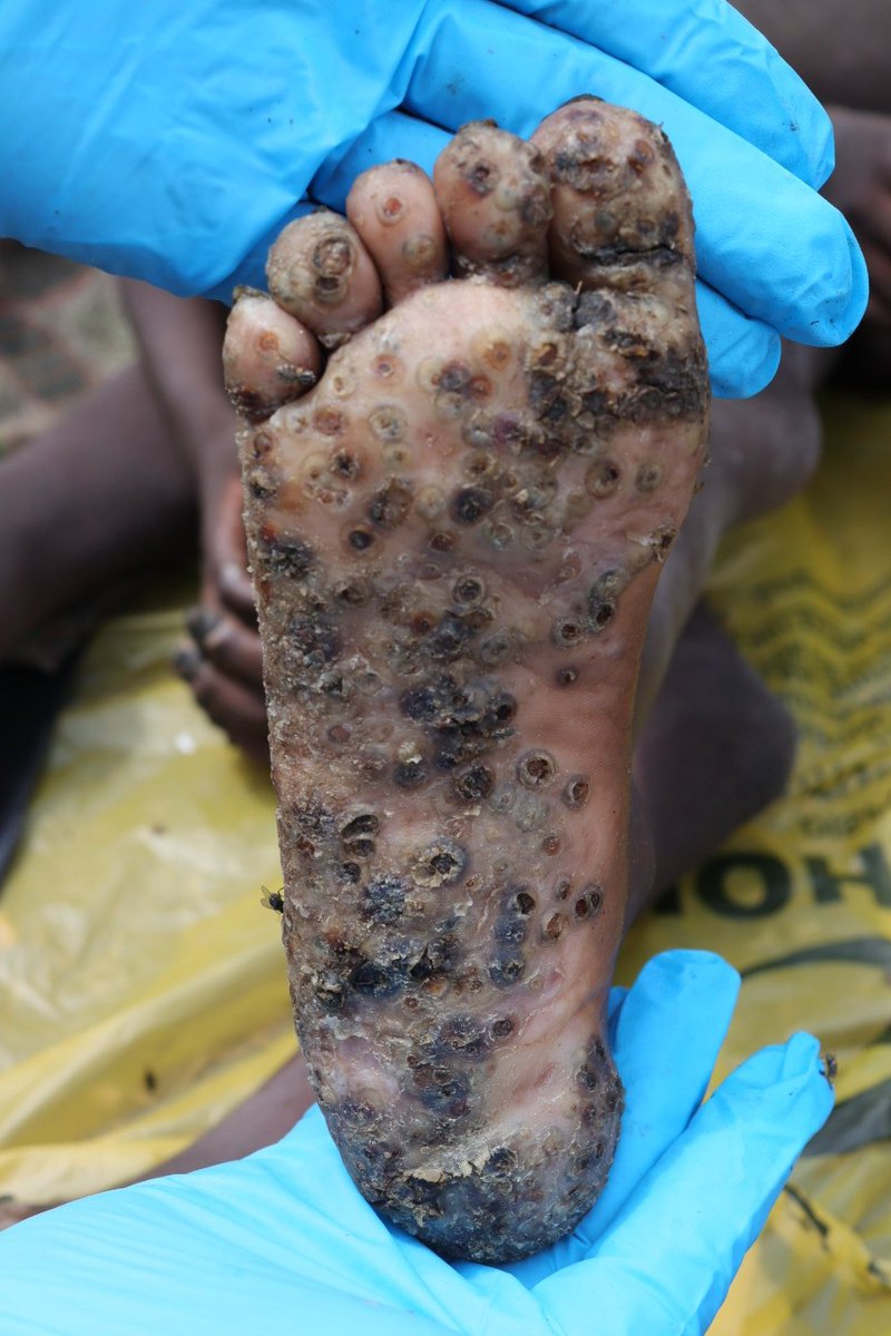 lelson (@lelson18) on Twitter photo On this #WorldNTDDay I want to make the world aware of the millions of children suffering from #tungiasis with NO treatment nor research grants available nor funds for control efforts from governments. Photo FrancisMutebi #BeatNTDs <a href="/gatesfoundation/">Gates Foundation</a> <a href="/Amref_Kenya/">Amref Health Africa in Kenya</a> <a href="/SamBankmanftx/">Sam Bankmanftx</a> On this #WorldNTDDay I want to make the world aware of the millions of children suffering from #tungiasis with NO treatment nor research grants available nor funds for control efforts from governments. Photo FrancisMutebi #BeatNTDs <a href="/gatesfoundation/">Gates Foundation</a> <a href="/Amref_Kenya/">Amref Health Africa in Kenya</a> <a href="/SamBankmanftx/">Sam Bankmanftx</a>