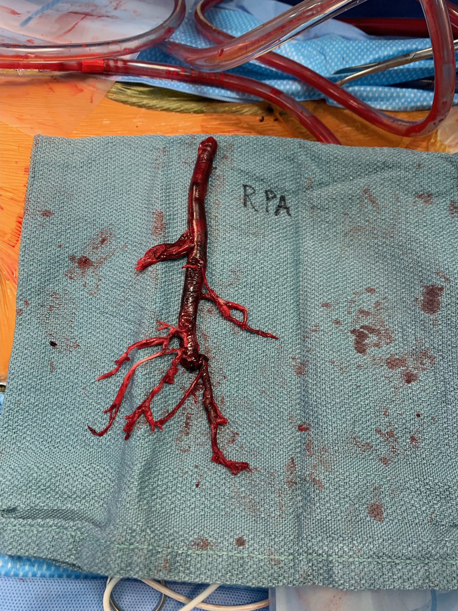 Jordan Hoffman (@avr_mvr) on Twitter photo Nice collaboration with <a href="/kashishgoelmd/">Kashish Goel</a> to rescue a sick patient with large clot burden in a patient with #COVID19. Clot in transit, #angiovac, instability requiring #ecmo, then OR. @VUMC_ECMO <a href="/vumcvalve/">Vanderbilt Structural Heart & Valve Center</a> <a href="/VUMChealth/">Vanderbilt Health</a> Nice collaboration with <a href="/kashishgoelmd/">Kashish Goel</a> to rescue a sick patient with large clot burden in a patient with #COVID19. Clot in transit, #angiovac, instability requiring #ecmo, then OR. @VUMC_ECMO <a href="/vumcvalve/">Vanderbilt Structural Heart & Valve Center</a> <a href="/VUMChealth/">Vanderbilt Health</a>