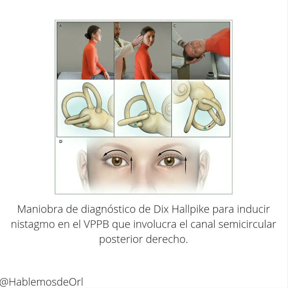 HablemosdeOrl's tweet photo. Se requiere valoración por un otorrinolaringologo, el cual hará un diagnóstico minucioso mediante maniobras diagnosticas ( Dix-Hallpike, Rosen, McClure...) Y proponer un tratamiento correcto ( habitualmente con maniobras de reposición: Epley, Gufoni, Apiani, Yacovino). https://t.co/mqzqHHL9Sc