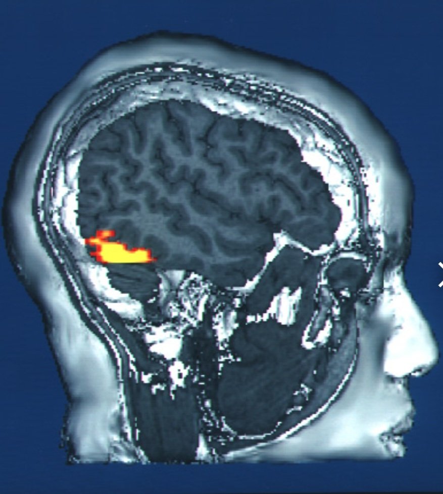 AliGhamdi2's tweet photo. في الدماغ منطقة متخصصة تسمى (Fusiform face area) مهمتها التعرف على الوجوه وكل وجه مرتبط بشبكة عصبية معقدة لمناطق أخرى مثل الذاكرة والمشاعر تتم إثارتها بطريقة مختلفة عند رؤية وجوه مختلفة بناءً على التجارب السابقة، فبعضها يثير الراحة أو الحنين وبعضها يثير الضيق أو الألم. https://t.co/GdIOOGGZ9Q