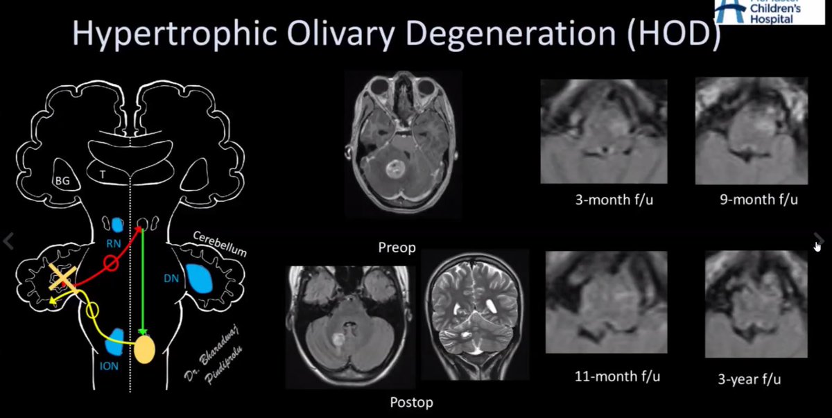 Dr Kish Mankad (@drmankad) on Twitter photo Best way to spend Sunday afternoon! Fantastic learning from our Canadian friends <a href="/spinacademics/">SPIN | Society of Pediatric Neuroimaging</a>. Incredibly curated cases. Gracias <a href="/ClaudiaMtzRios/">Claudia MartinezRios</a> <a href="/matadaddy/">Daddy Mata, MD., PhD.</a> <a href="/nihaal08/">Nihaal Reddy</a> <a href="/Ann016p/">Anvita Pauranik</a> <a href="/elka_miller/">Elka Miller</a> <a href="/SKPedRadFellows/">SK Ped Rad Fellows</a> @JSidpra <a href="/zguroztekin/">Özgür Öztekin</a> <a href="/DrTaranath/">Dr. Ajay Taranath</a> <a href="/robgoetti/">Robert Goetti</a>! Best way to spend Sunday afternoon! Fantastic learning from our Canadian friends <a href="/spinacademics/">SPIN | Society of Pediatric Neuroimaging</a>. Incredibly curated cases. Gracias <a href="/ClaudiaMtzRios/">Claudia MartinezRios</a> <a href="/matadaddy/">Daddy Mata, MD., PhD.</a> <a href="/nihaal08/">Nihaal Reddy</a> <a href="/Ann016p/">Anvita Pauranik</a> <a href="/elka_miller/">Elka Miller</a> <a href="/SKPedRadFellows/">SK Ped Rad Fellows</a> @JSidpra <a href="/zguroztekin/">Özgür Öztekin</a> <a href="/DrTaranath/">Dr. Ajay Taranath</a> <a href="/robgoetti/">Robert Goetti</a>!