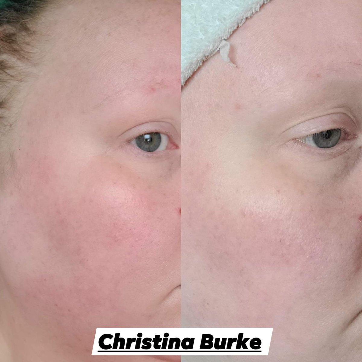 crissyb_14's tweet photo. It's been a long damn time since I had regular skincare, and I love what this Tea Tree line has been doing for the redness and oilyness in my skin!! https://t.co/skKAKKtsCO