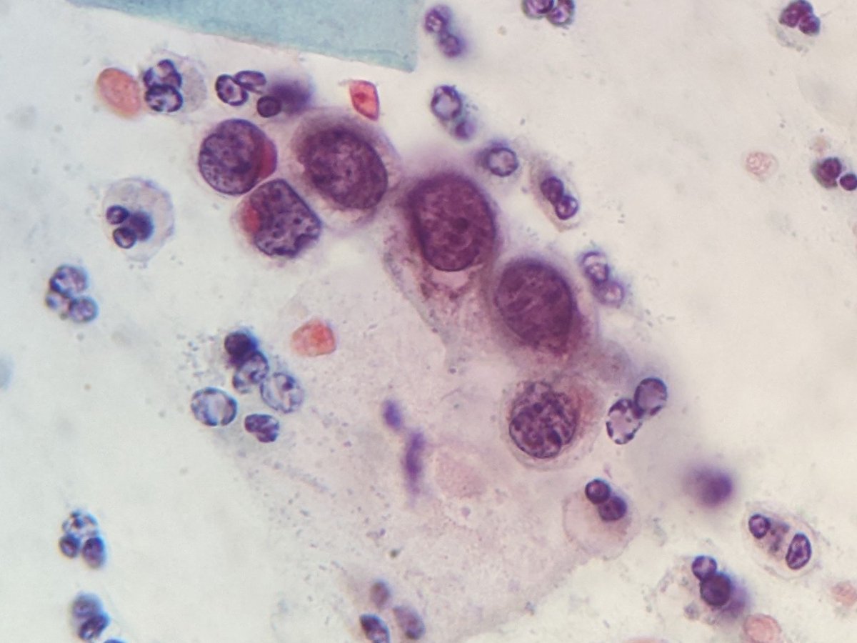 PSzwebel's tweet photo. Conventional PAP smears
HSIL, CINIII https://t.co/frU5bldTLU