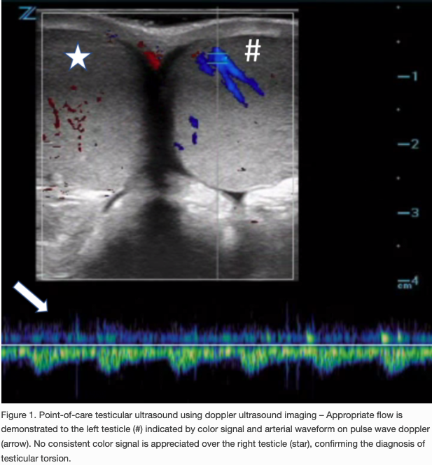 POCUSJournal's tweet photo. CASE: 13-y/o male w/ acute scrotal pain, afebrile & hemodynamically stable. Genital exam➡️firm high-riding R. testicle, tender on palpation. See how #POCUS established testicular torsion Dx, guided manual detorsion, & confirmed restored blood flow: https://t.co/M1eCh4oW7o
#FOAMed https://t.co/ecuPZk6o5P