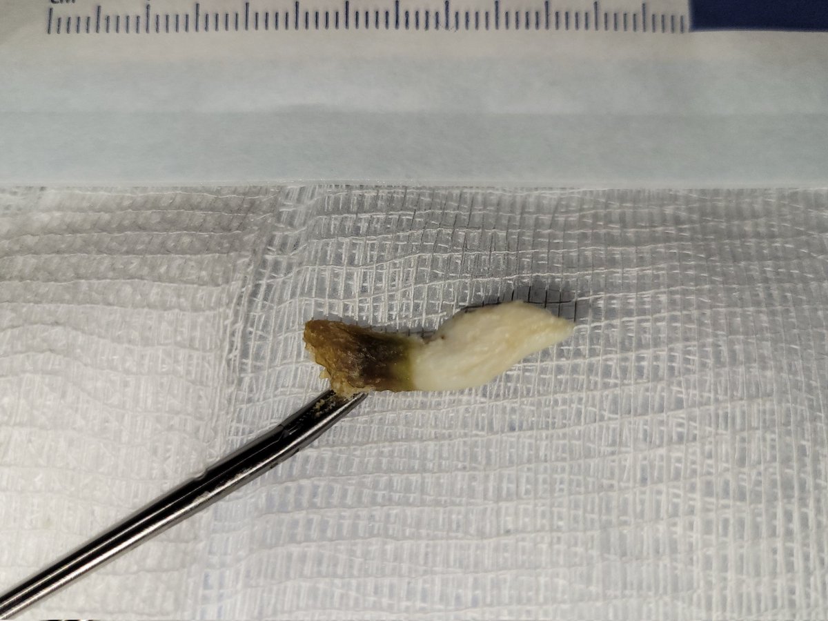 dycho98's tweet photo. It is an art to pull out an entire earwax as one piece!! ๐ Perfect coordination between your grasping force/location, pulling (wiggle) directions, and finally the texture of earwax!!! #loveENT https://t.co/YQFdGcBwrA