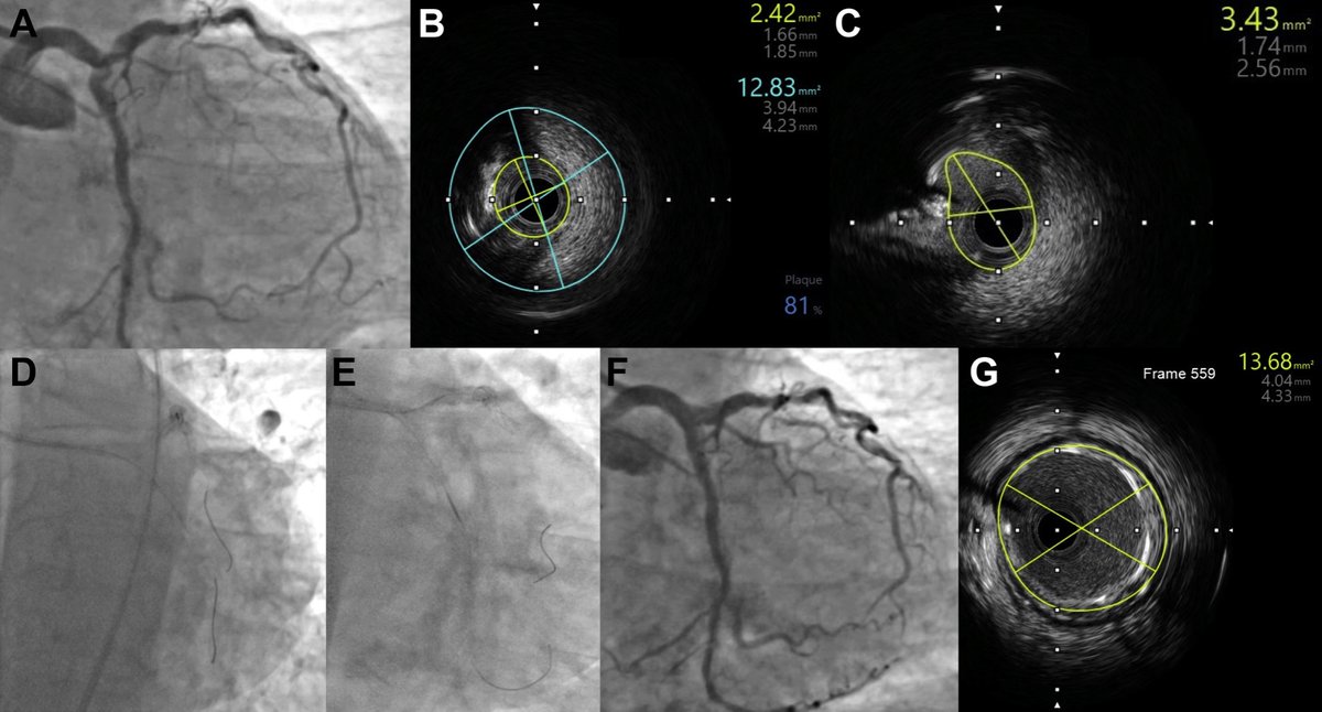 Our case published in the first issue of @MyJSCAI - Successful Orbital Atherectomy of Left Main Bifurcation Using Microcatheter Protection of Nonatherectomy Wire sciencedirect.com/science/articl… @aesullivan37 @VUMChealth @VUMC_heart @SidakpalP @DrArgyle