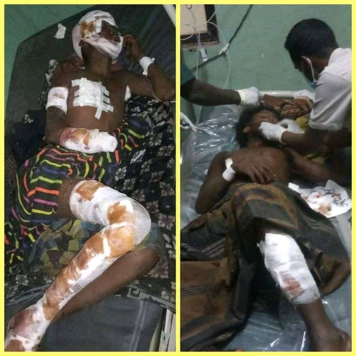 AhmedibnAfar776's tweet photo. TPLF terrorists are massacring innocent Afar every day with heavy weapons.
 #AfarUnderAttack

የህወሓት አሸባሪዎች በየቀኑ በከባድ መሳሪያዎች የአፋር ንፁሃንን እየጨፈጨፈ ይገኛል።
#AfarUnderAttack https://t.co/z51AqNREF8