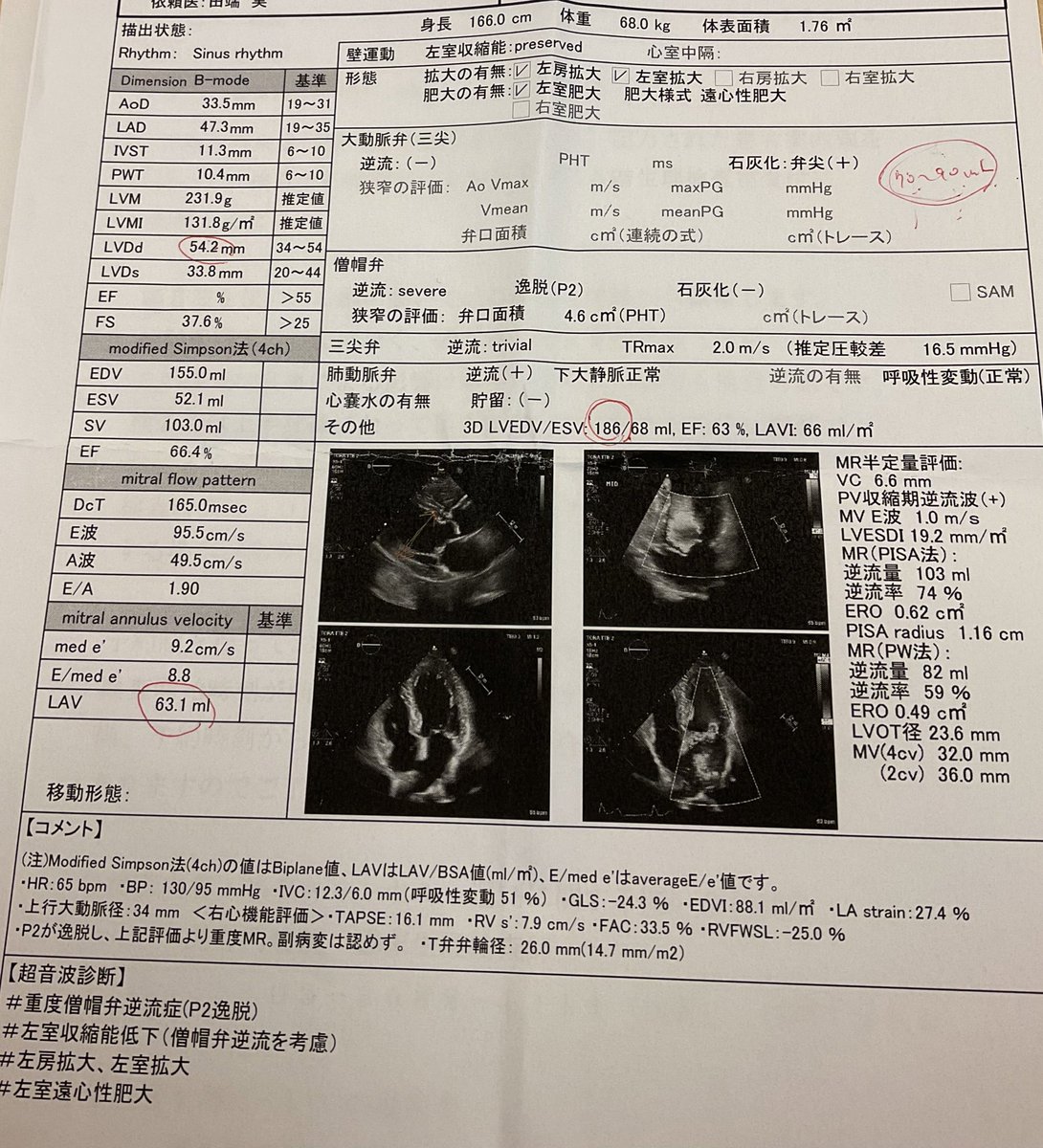 benmakusunn's tweet photo. 1枚目が今回のエコーで2枚目が手術前のエコー。逆流率75％って。。。w https://t.co/UZwHW3QCRj