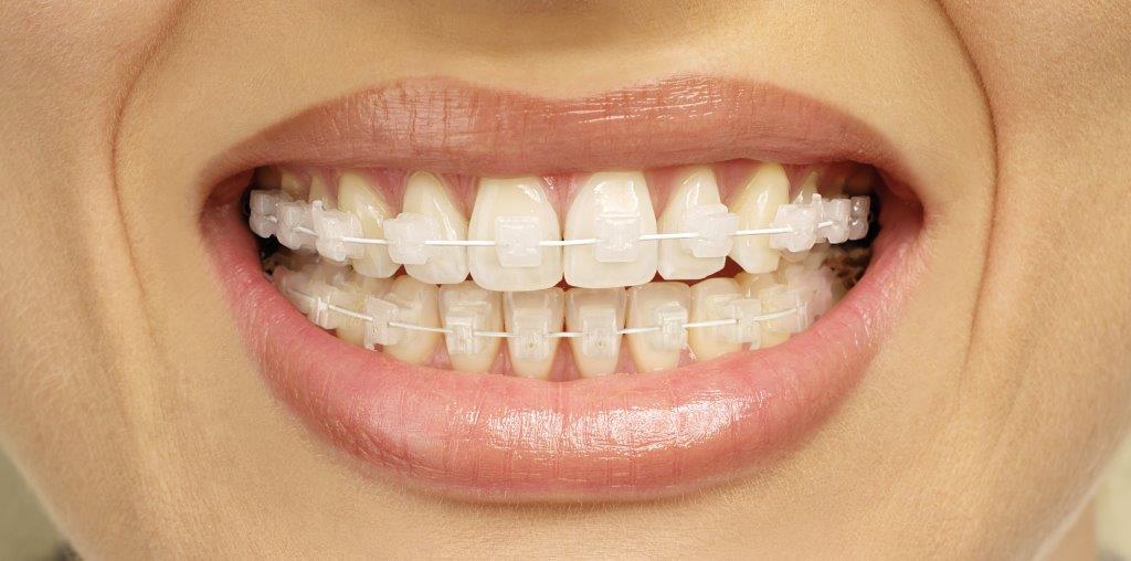 Ceramic cosmetic braces only use wire in the connections, opting instead for ceramic mounds on the teeth where metal would be usually. bit.ly/2rPWqy8