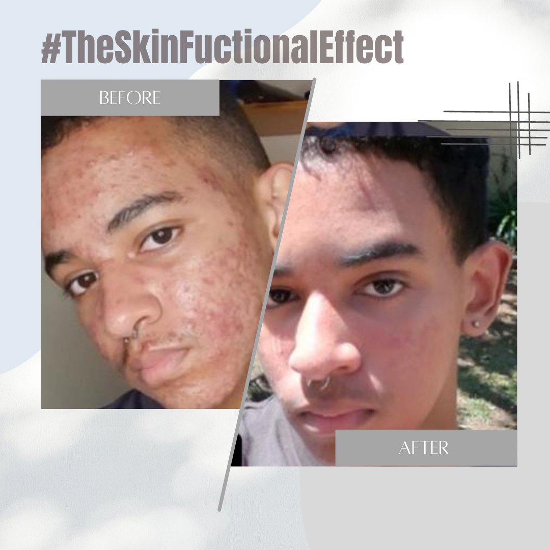 SkinFunctional's tweet photo. These #SkinFunctionalEffect results speak for themselves. π
We'd love to see your results so be sure to tag us in your journey with #TheSkinFunctionalEffect to join the conversation. π
#SkinFunctional #skincareza #skincarebusiness #skinprogress #summerskincare https://t.co/Q2w2CQv1M8