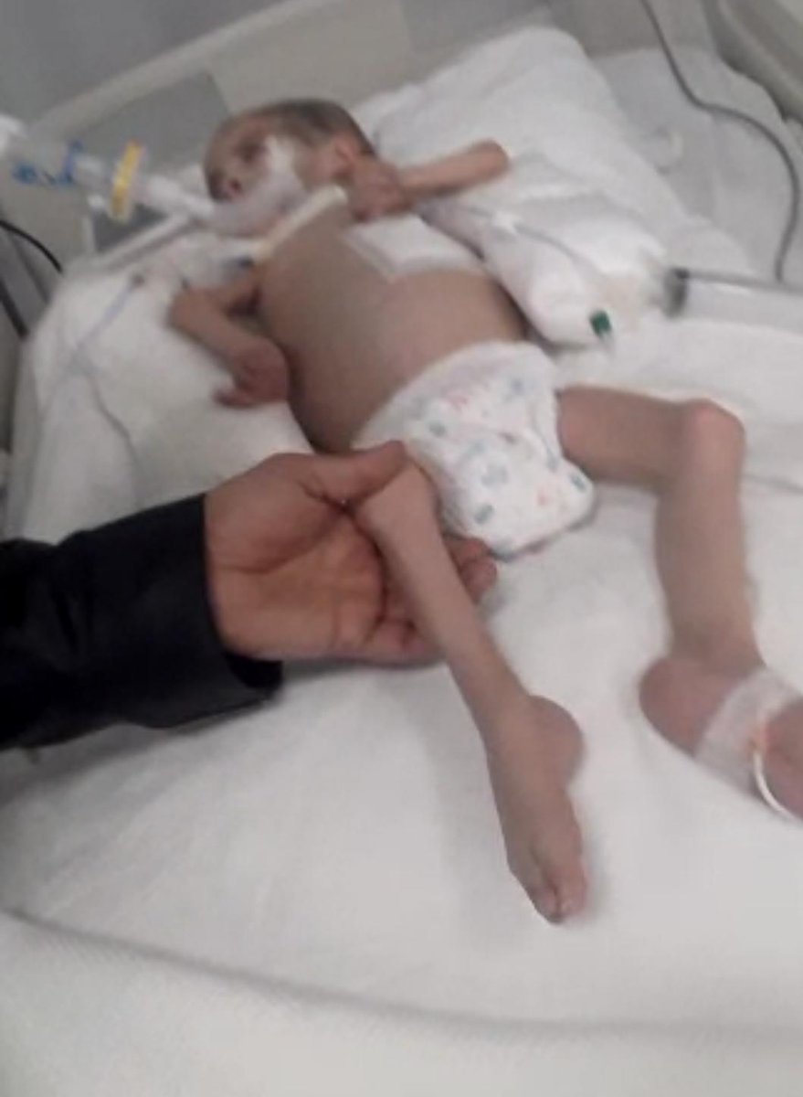 Ahmed'in babası bugün onu ziyarete hastaneye gitti. Ahmed, dün gece kötüleşmiş... Bugün biraz daha durumu iyi ama artık zamanı kalmadı! SMA hastalığının en ağır türü olan tip-1 hastası ve 1 doz bile Spinraza ilacı alamadı. 3 yaşına girdi, daha ne kadar ilaçsız dayanabilir?