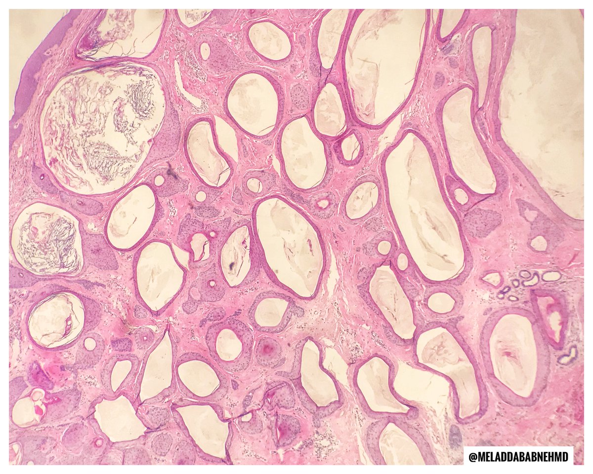 EmoryPathology's tweet photo. 🔬EMORY CASE OF THE WEEK #62:
.
35 M with slowly growing dermal mass. 
Contributors: @MeladDababnehMD
.
#Dermpath #pathresidents #Emorypathres #EmoryCoTW #PathTwitter #Path2Path #PathMatch22 #PathMatch2022 https://t.co/cMhpIIzCrU