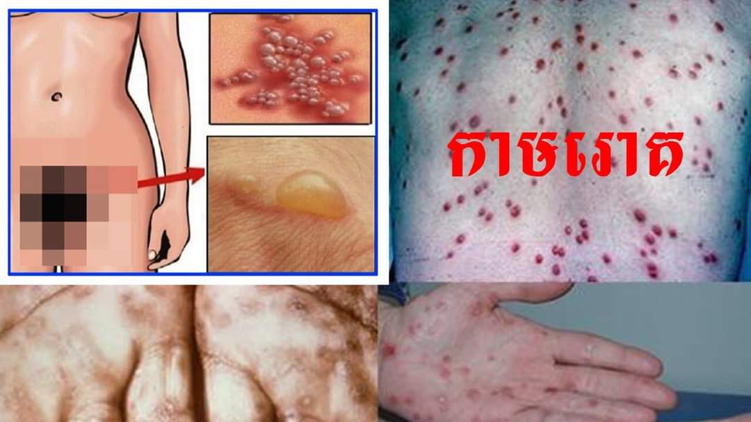 រោគសញ្ញានៃជំងឺកាមរោគ! 💉ឆាប់ធ្វើតេស្តនឹងទទួលការព្យាបាល💊ដោយឥតគិតថ្លៃរក្សាការសំងាត់
📲📩0964467555(telegram)
          099995602