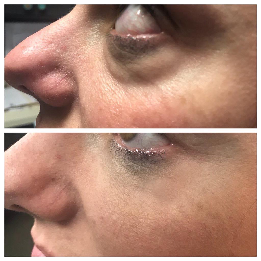 SeiBellaLR's tweet photo. #Restylane #Refyne in the #teartroughs and lateral orbits to correct volume loss. This gives her a much more rested look. Placed with a 25 gauge #cannula to minimize bruising and swelling. #drannetrussell 👩⚕️ #seibellamedspa #filler #antiaging 501-228-6237 👀 https://t.co/SnCMD5kR98