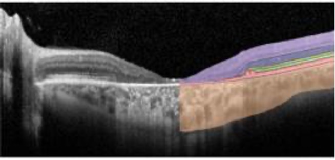 #NEIfunded research classifies vision loss and retinal changes in Stargardt disease . Learn how: nei.nih.gov/about/news-and…