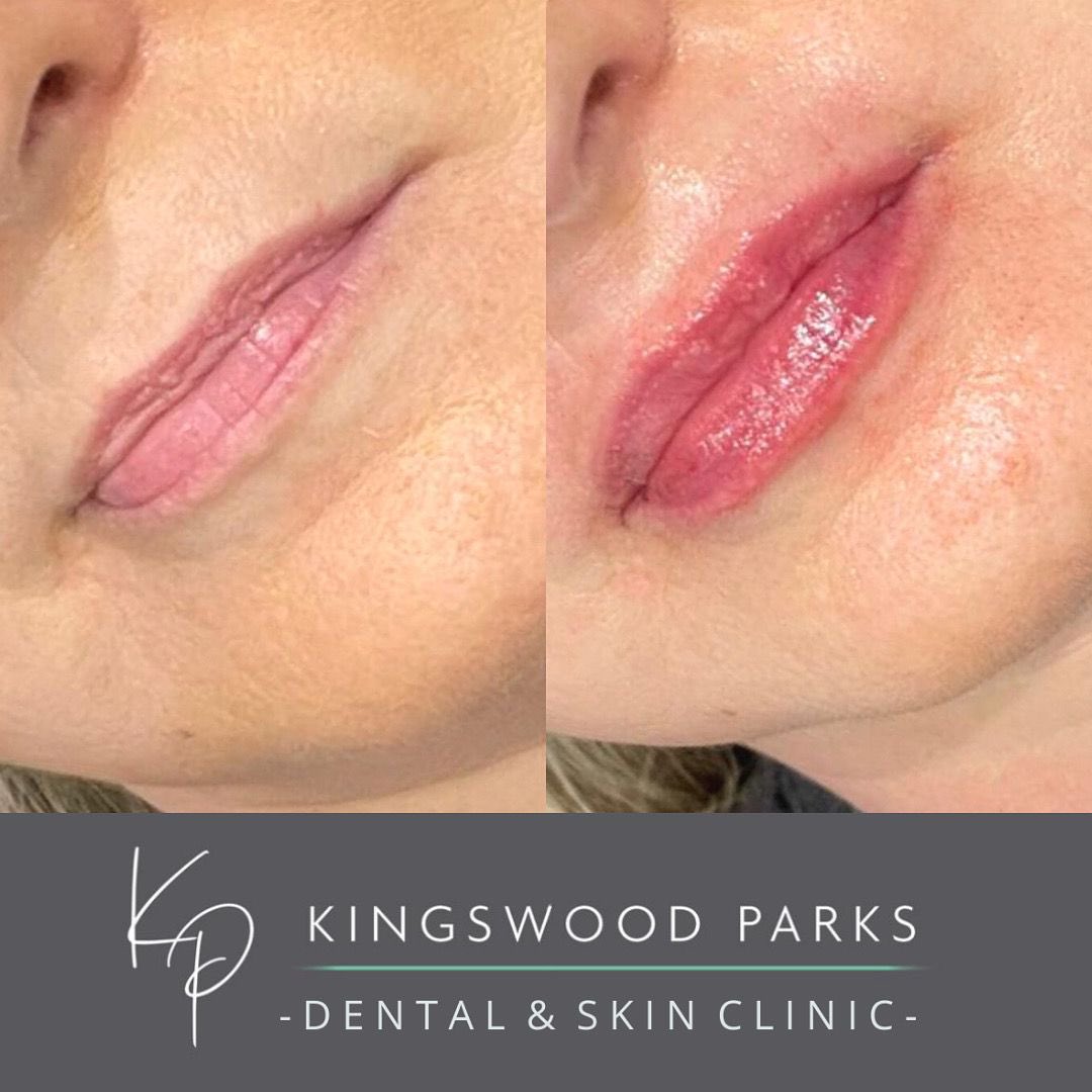 KPClinics's tweet photo. The power of Lip Enhancement! #lipfiller #lipenhancement #hull #skinclinic #aesthetics https://t.co/oSKV2MuJuo