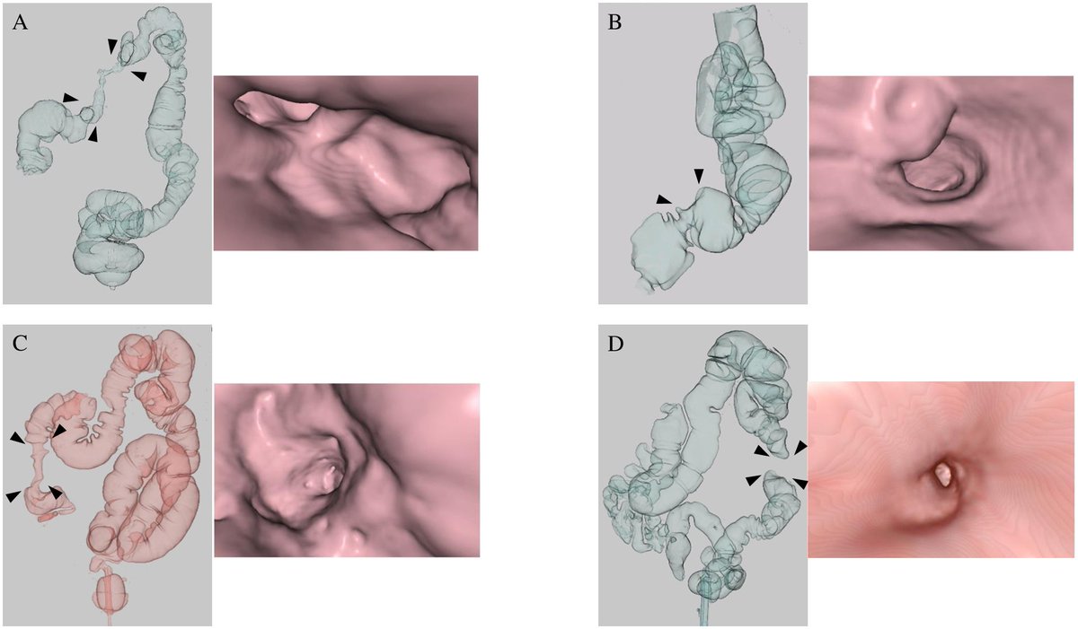 polom_karol's tweet photo. Assessment of the use of computed tomography #colonography in early detection of #peritonealmetastasis in patients with #gastriccancer: A prospective cohort study @PLOSONE #PLOSONE @SPeritoneum https://t.co/KggC7zRzZf https://t.co/MrBZVOLxNy
