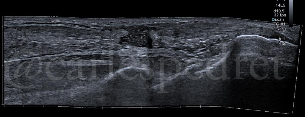 Have you ever seen a really recent complete achilles #tendon rupture?? This one is less than 4 h after the injury mechanism in a professional #basketball player. #ultrasound longitudinal panoramic view.