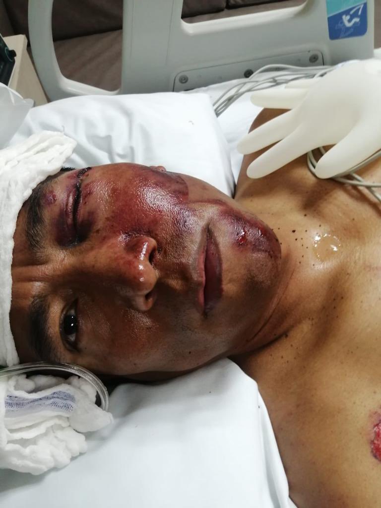 8Policross's tweet photo. El 22 de enero caí en un bache en el bajo puente de Eje Central, por Garibaldi. Fui a dar a carriles centrales donde me atropelló un auto. Tengo cinco costillas rotas, un pulmón perforado y más huesos rotos. Justo ahora hay ciclistas que pasan por ahí y corren peligro. ¡BASTA! https://t.co/TGkGBUBhwt