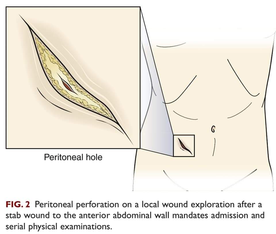 DRAFTABAHMED7's tweet photo. Penetrating Abdominal 
Trauma.
𝗥𝗲𝗳:Current surgical therapy 13th ed, 2020.
#GITwitter 
#Medtwitter 
#penetratingtrauma
#exploratorylaparotomy https://t.co/iaRqoRbaSP