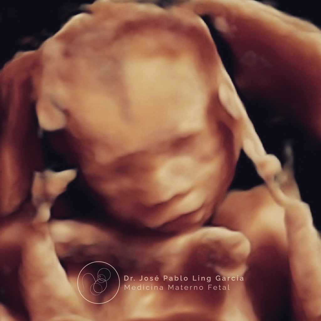 Drpabloling's tweet photo. Ultrasonido estructural 👶🏻

#ultrasonido 
#embarazo 
#embarazosaludable 
#3d
#medicina 
#bebe 
#obstetricia https://t.co/VSl58hnZe1